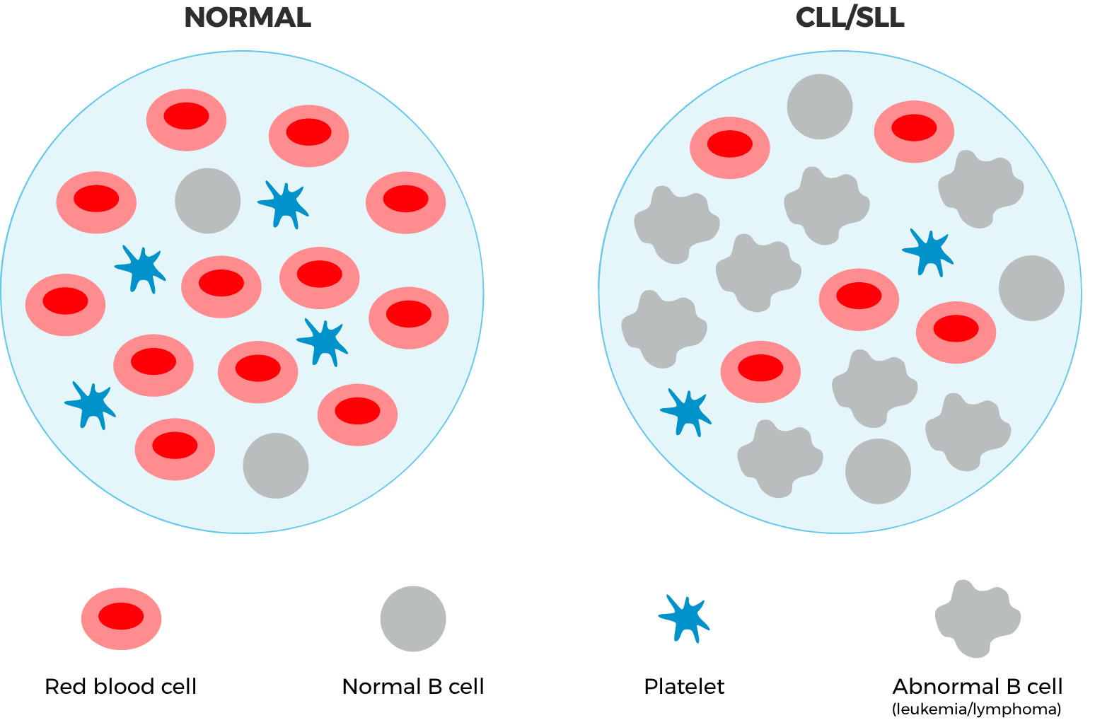 Normal cells vs CLL/SLL cancer cells